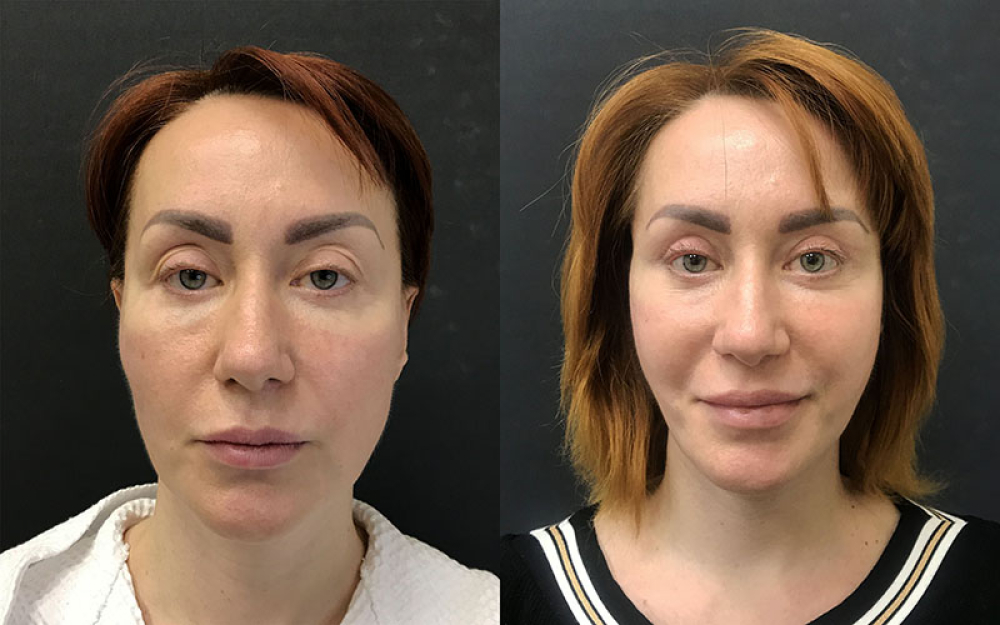 Пациентка хирурга Ованесовой О.А. до и после омоложения лица и шеи
