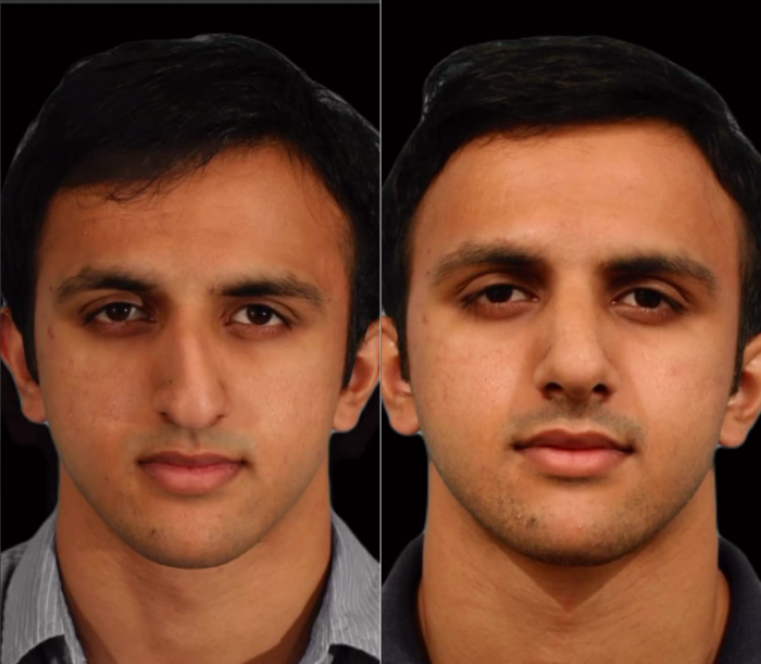 Пациент хирурга Гукаса Миракяна до и после ринопластики