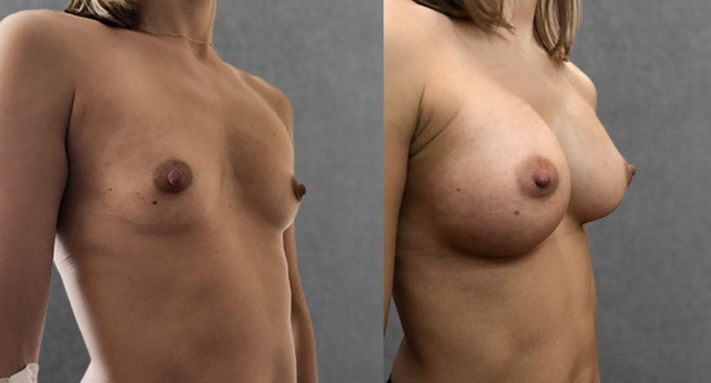 Пациентка доктора Дмитрия Крысина до и после увеличения груди имплантами
