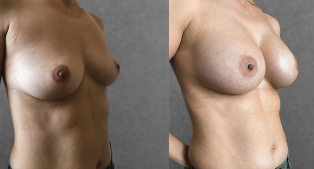 Пациентка доктора Дмитрия Крысина до и после увеличения груди имплантами