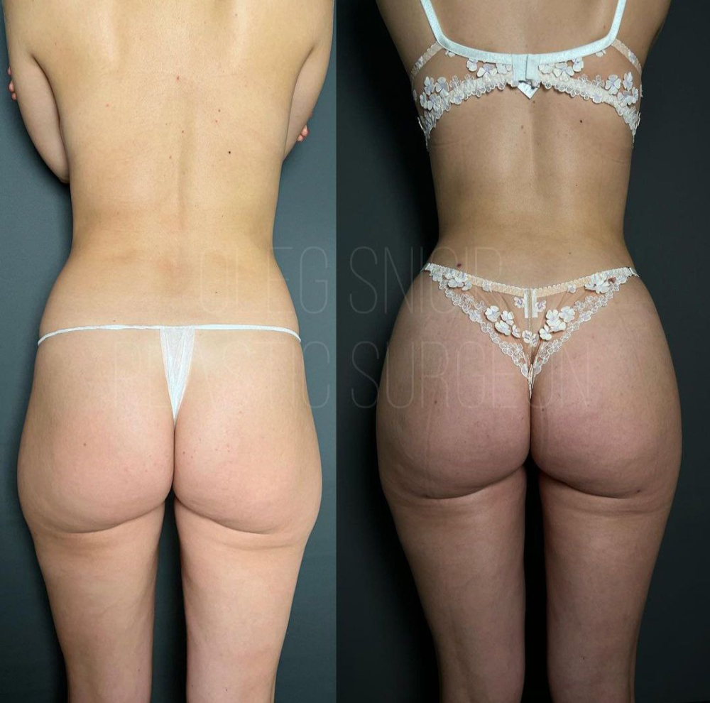 Пациентка доктора Олега Снигиря. Фото до и после липомоделирования фигуры и липофилинга ягодиц.