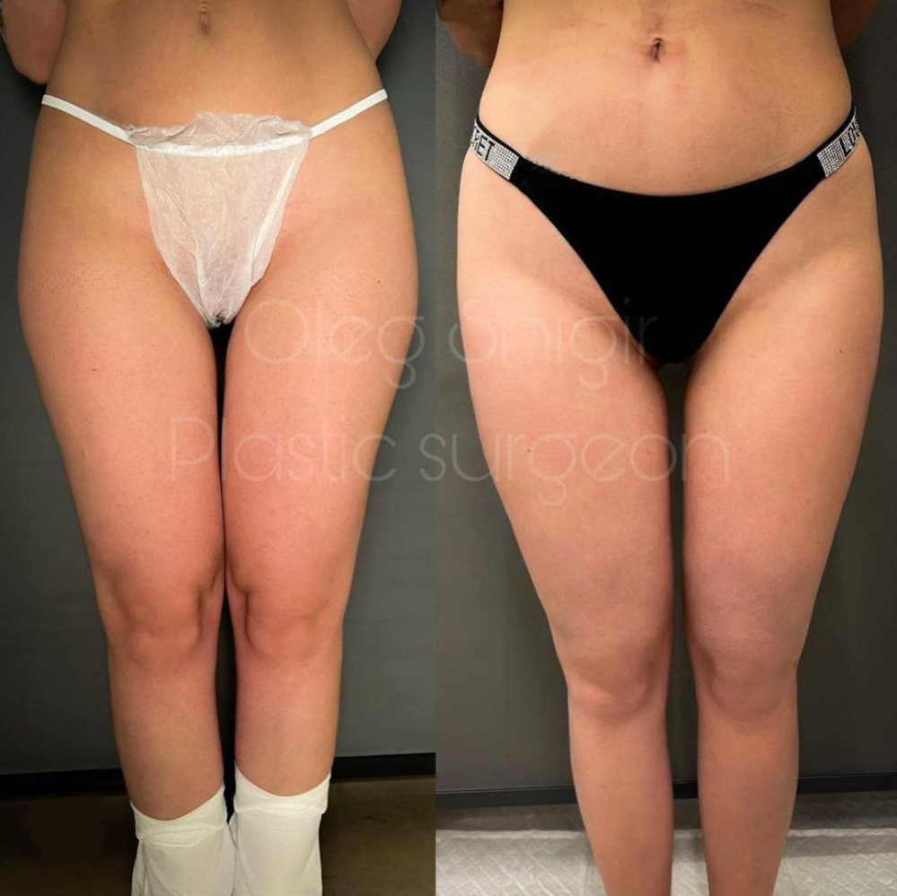 Пациентка доктора Олега Снигиря. Фото до и после липосакции бедер и колен.