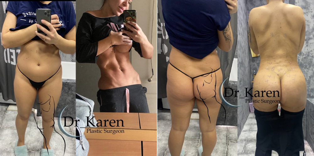 Пациентка доктора К.Пайтяна. Фото до и после липомоделирования тела с увеличением ягодиц.