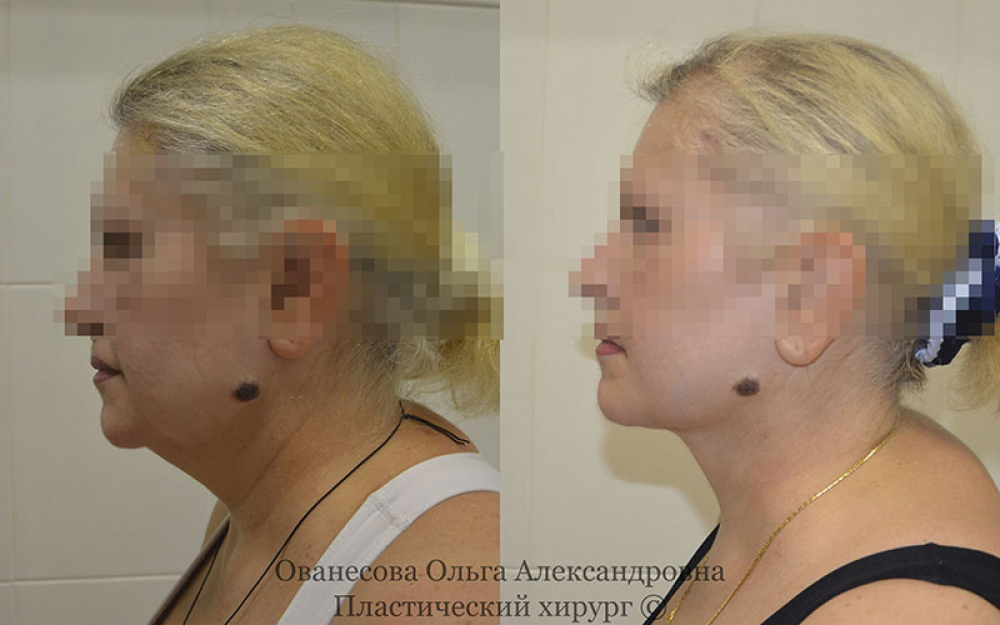 Пациентка пластического хирурга О. Ованесовой. Женщине была проведена липосакция нижнего контура лица