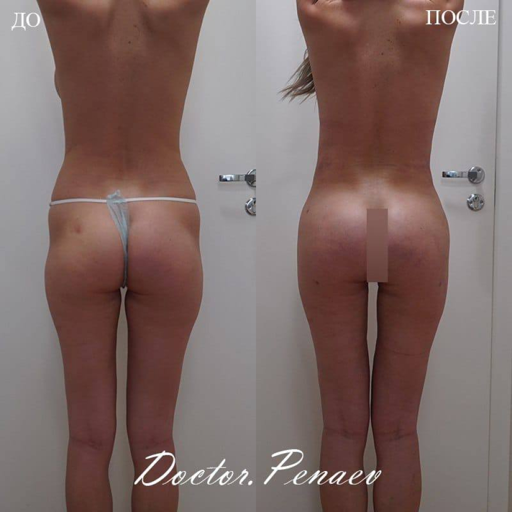 Пациентка (29 лет) проф. Пенаева А.А. Доктором была выполнена мультизональная VASER-липосакция и липотрансфер ягодиц