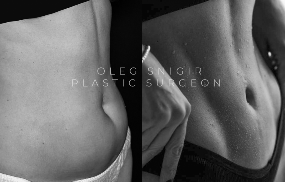 Пациентка доктора Олега Снигиря до и после спортивного липомоделирования тела