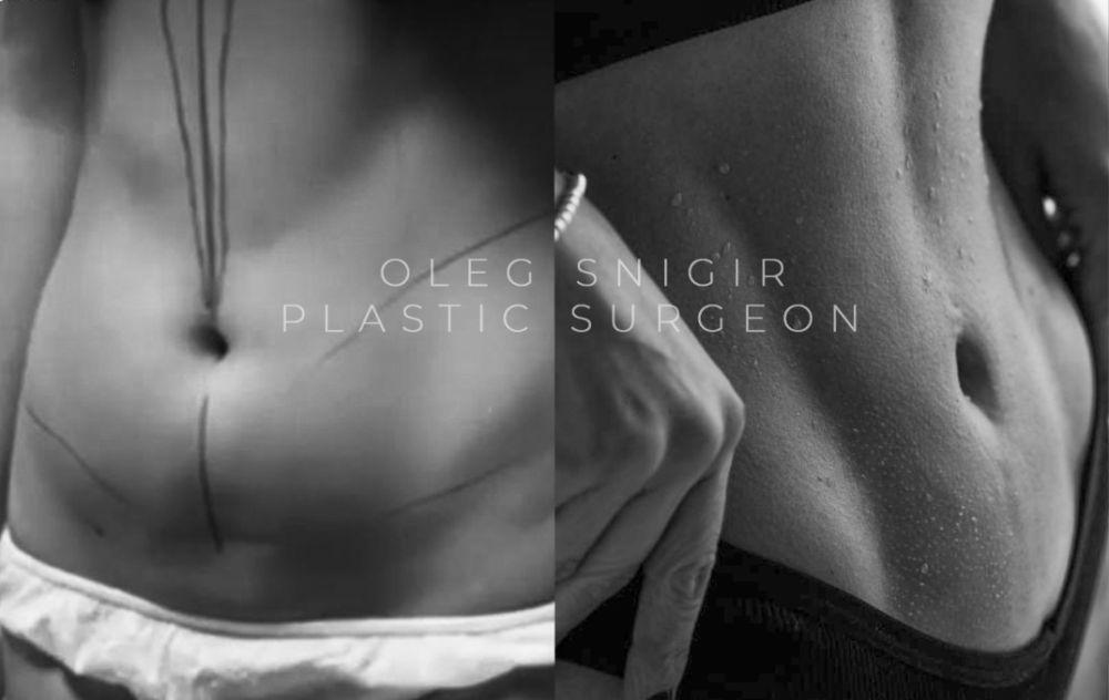 Пациентка доктора Олега Снигиря до и после спортивного липомоделирования