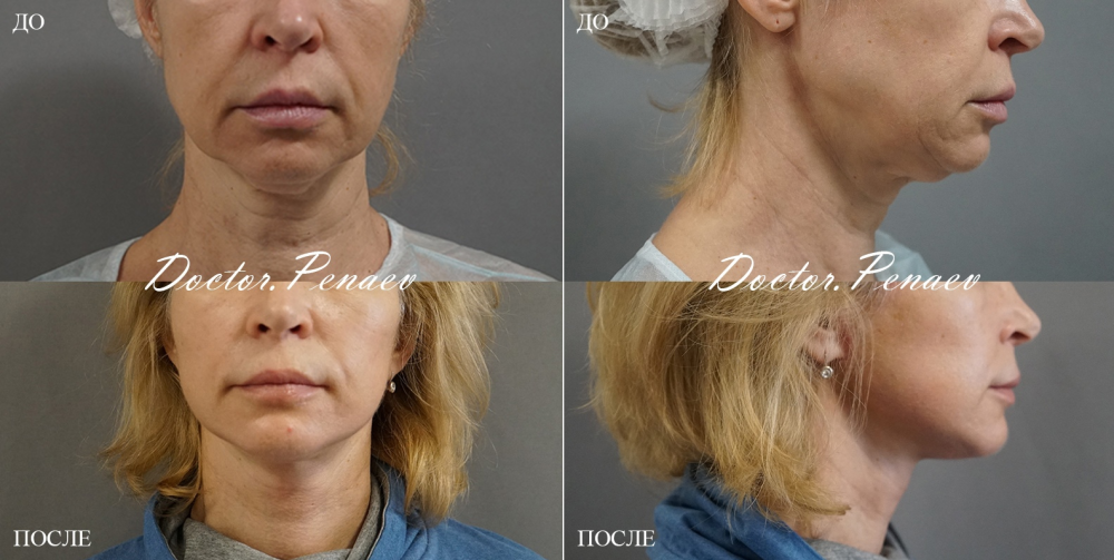 Пациентка доктора Пенаева. Выполнена SMAS-пластика с ультразвуковой диссекцией тканей.