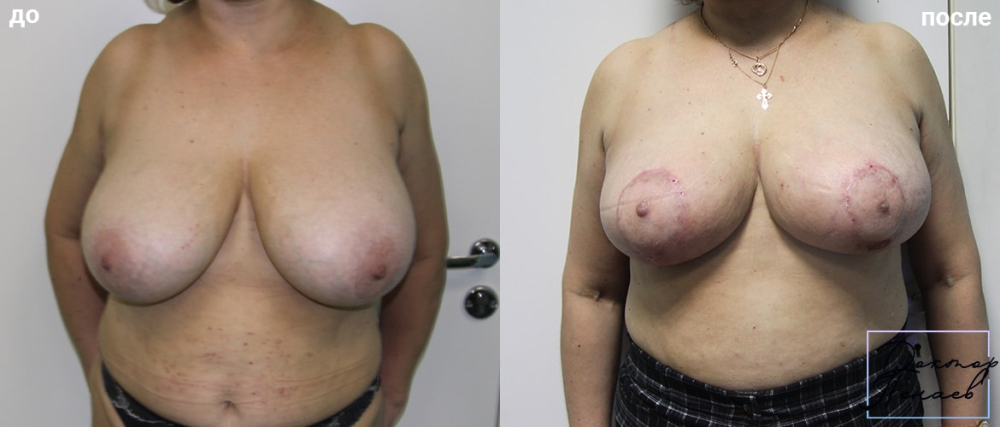 Фото пациентки доктора Пенаева до и после маммопластики