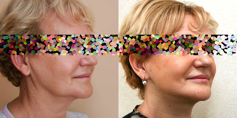 Пациентка пластического хирурга Александра Жукова до и после омолаживающей операции по подтяжке лица