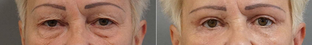 Пациентка пластического хирурга Арслана Пенаева до и после верхней блефаропластики