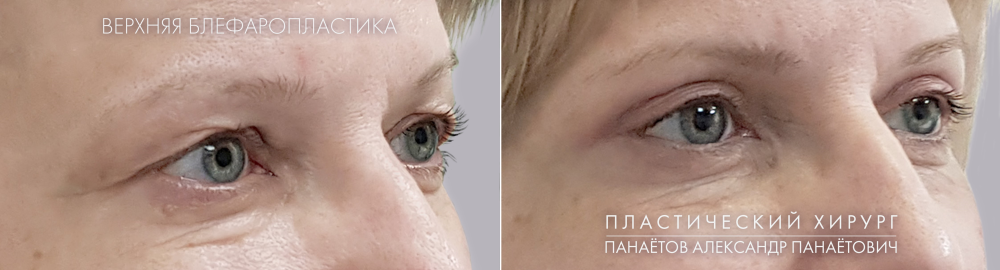 Пациентка доктора Панаётова. Фото до и после верхней блефаропластики