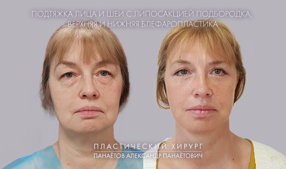 Пациентка доктора Панаётова. Фото до и после комплексно	й омолаживающей операции лица и шеи