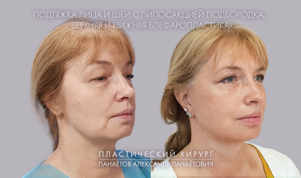 Пациентка доктора Панаётова. Фото до и после комплексно	й омолаживающей операции