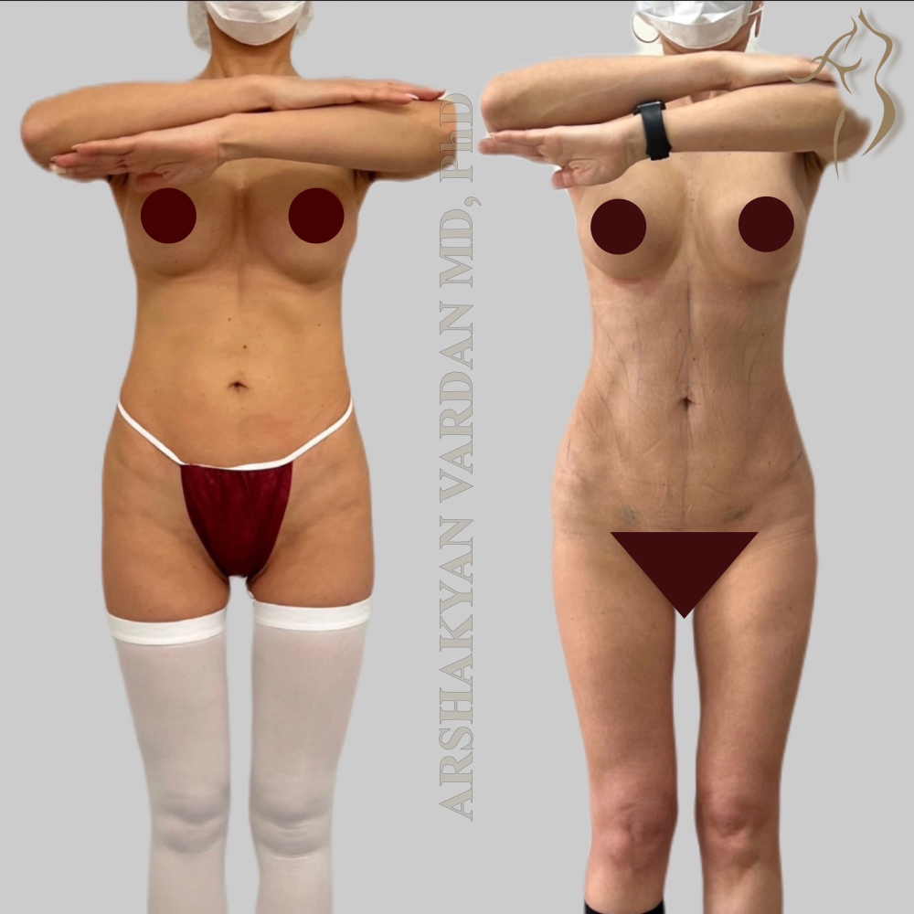 Пациентка пластического хирурга Вардана Аршакяна до и после операции по формированию узкой талии и атлетизацией живота