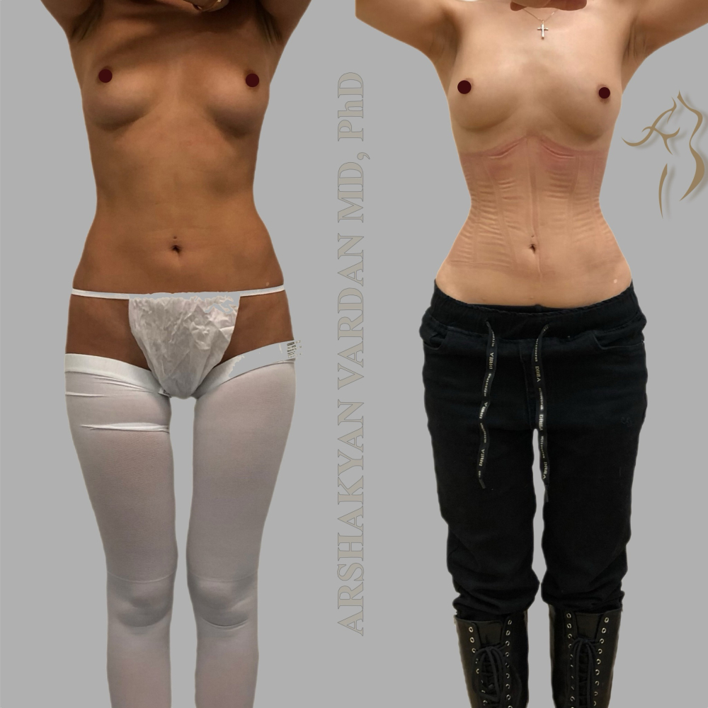 Пациентка пластического хирурга Вардана Аршакяна до и после операции по формированию узкой талии.