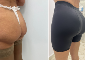 Дмитрий Крысин. Фото пациентки до и после реэндопротезирования ягодиц