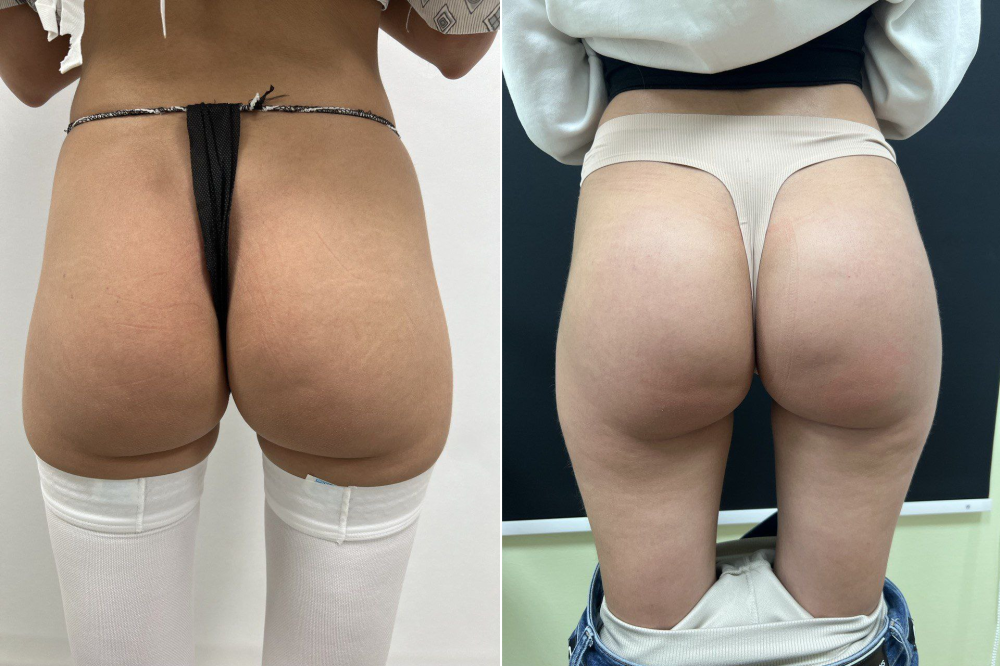 Дмитрий Крысин. Фото до и после увеличения ягодиц имплантатами