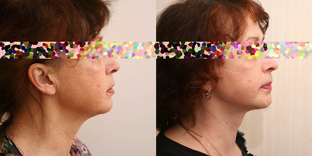 Пациентка хирурга Александра Жукова. Фото до и после операции по подтяжке лица