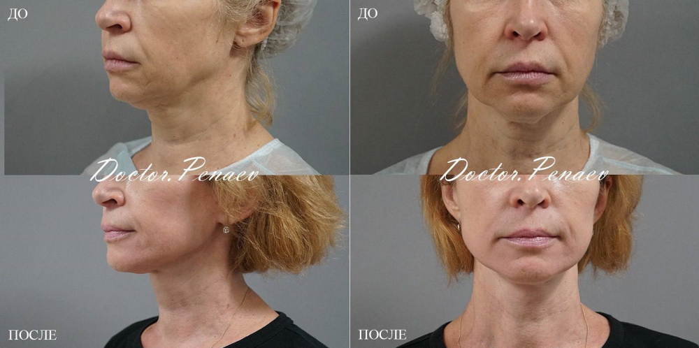 Пациентка профессора Арслана Пенаева до и после омоложения лица. Женщине был выполнен SMAS-лифтинг с ультразвуковой диссекцией тканей