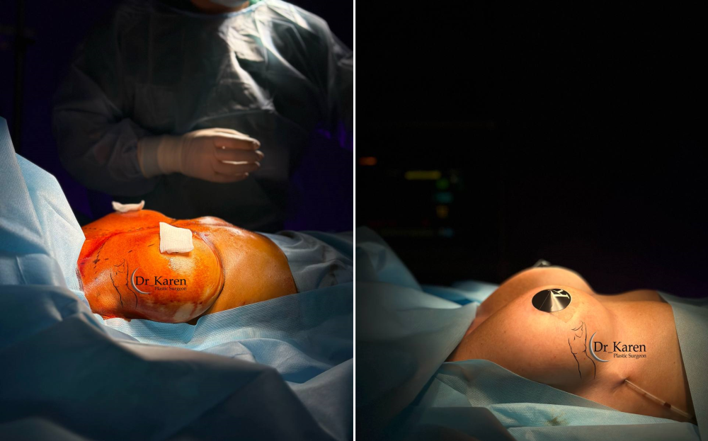 Пациентка доктора Пайтяна до и после реэндопротезирования груди