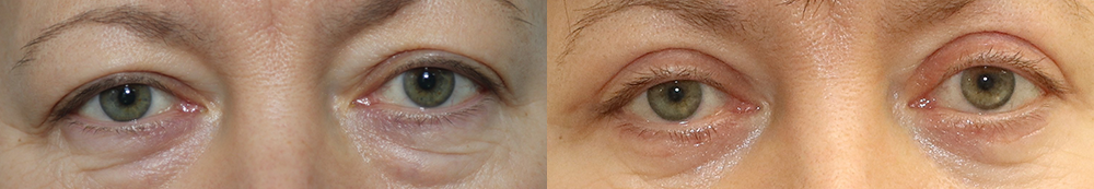 Александр Жуков блефаропластика