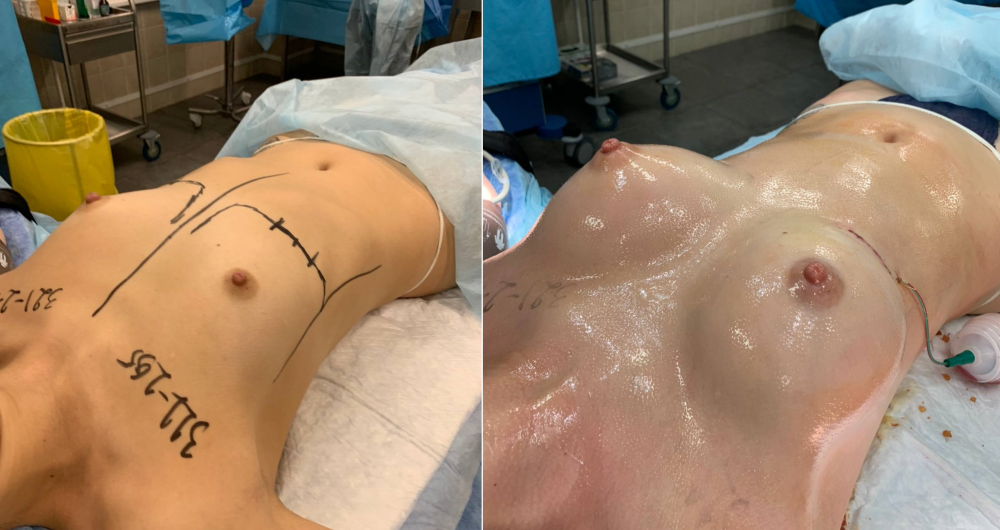 Пациентка до и после увеличения груди имплантами. Оперирующий хирург Довгалюк И.В.