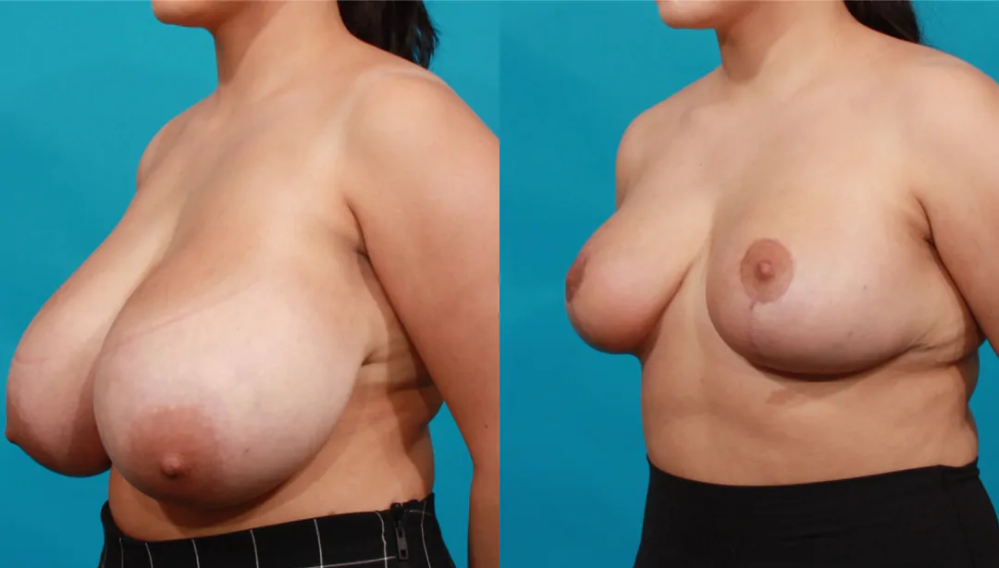 Пациентка пластического хирурга Гукаса Миракяна до и после операции по уменьшению груди