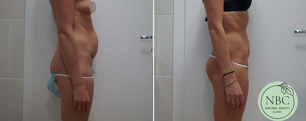 Пациентка пластического хирурга Арслана Пенаева. Фото до и после абдоминопластики с удалением пупочной грыжи