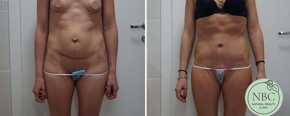 Пациентка пластического хирурга Арслана Пенаева. Фото до и после абдоминопластики с удалением пупочной грыжи.
