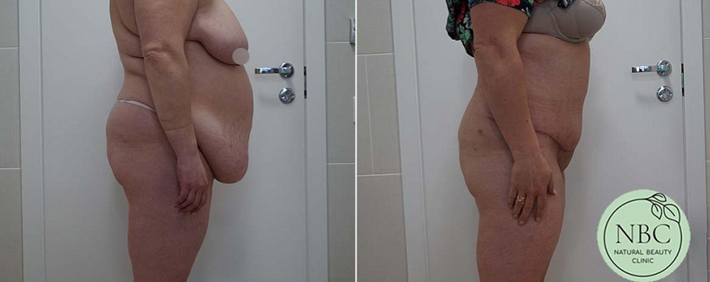 Пациентка пластического хирурга Арслана Пенаева. Фото до и после полной абдоминопластики. Снимок «после» снят в дни ранней реабилитации