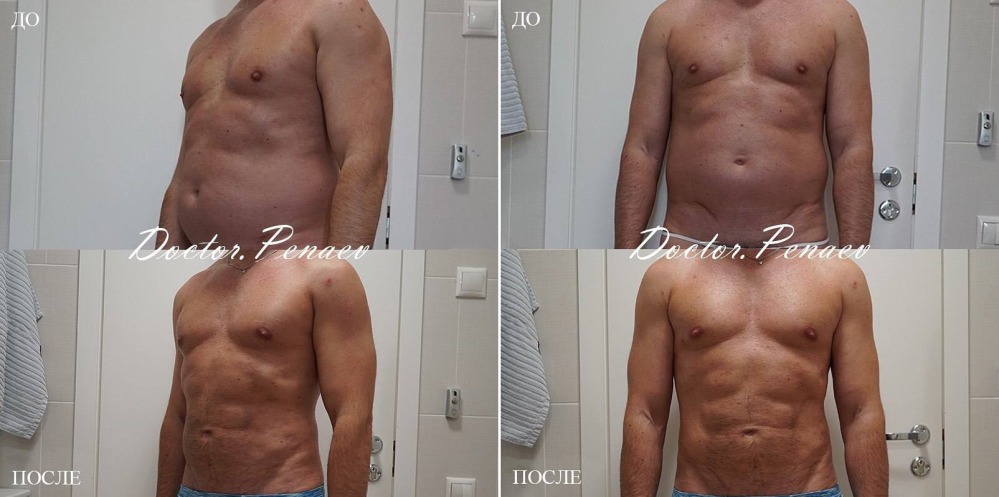 Пациент доктора Арслана Пенаева до и после вазер-липосакции