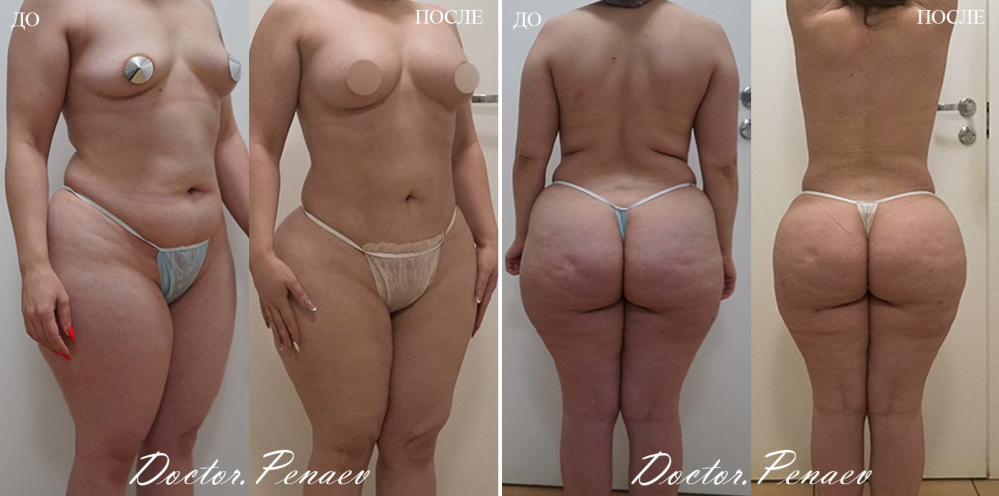 Пациентка (43 года) пластического хирурга Арслана Пенаева. Фото до и после мультизональной вазер-липосакции