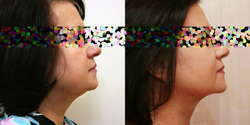 Пациентка хирурга Александра Жукова. Фото до и после омолаживающей операции лица