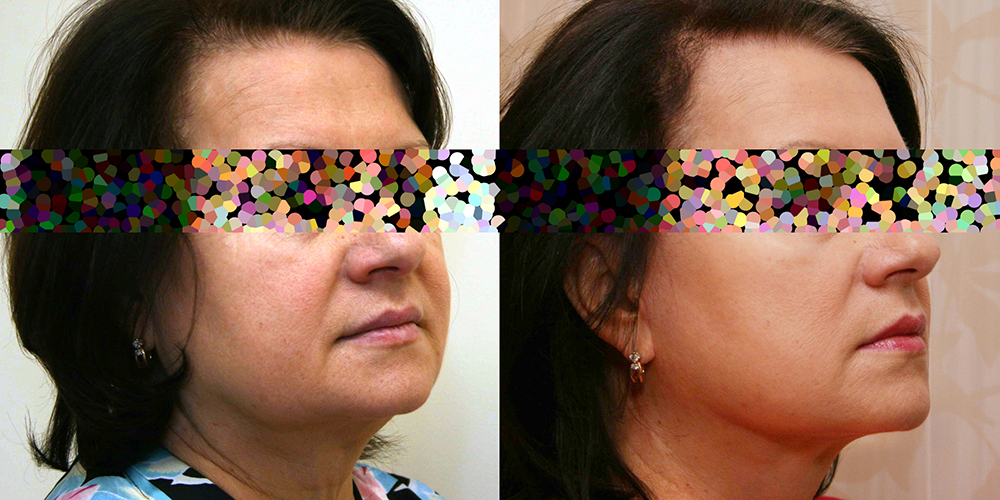 Пациентка доктора Александра Жукова. Фото до и после омолаживающей операции лица