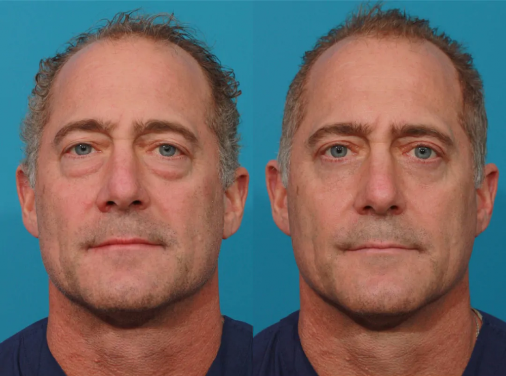 Пациент пластического хирурга Гукаса Миракяна до и после блефаропластики