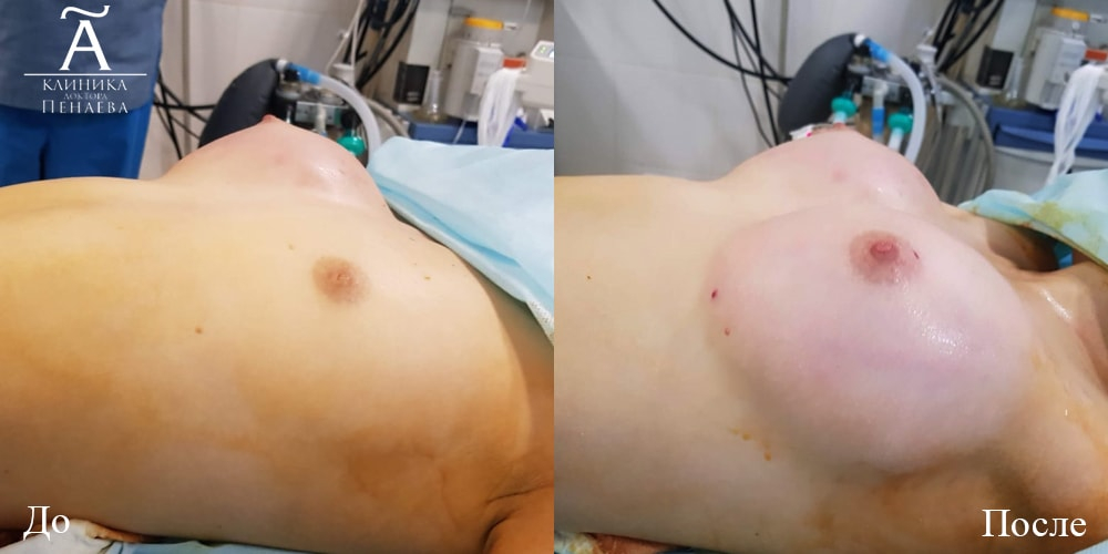 Пациентка пластического хирурга Арслана Пенаева. Фото до и после липофилинга груди