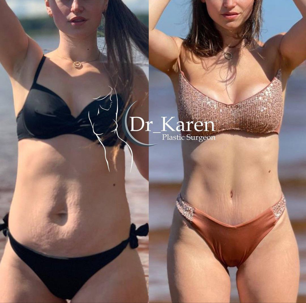 Пациентка пластического хирурга Карена Пайтяна. Фото до и после комплексного послеродового восстановления фигуры «ПостНатал»