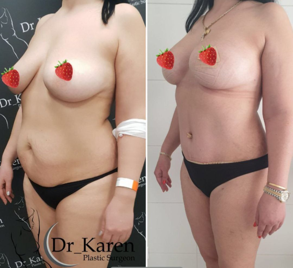 Пациентка пластического хирурга Карена Пайтяна. Фото до и после комплексного послеродового восстановления фигуры ПостНатал
