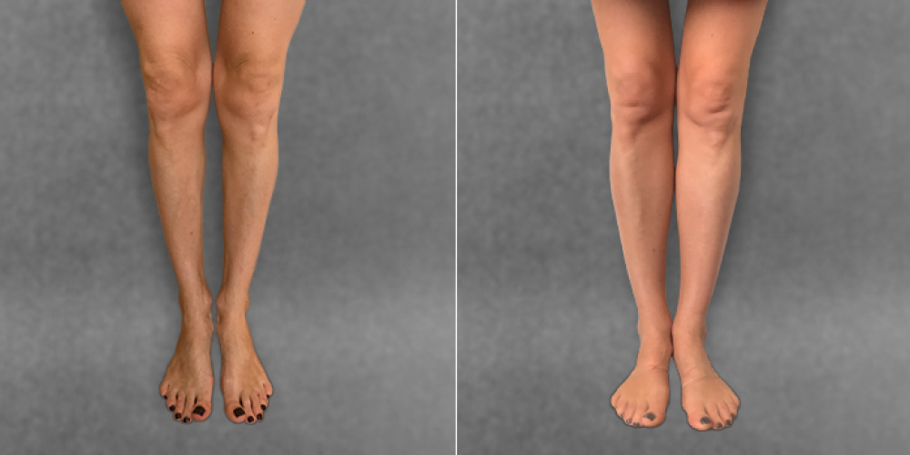 Пациентка московского доктора Дмитрия Крысина до и после круропластики