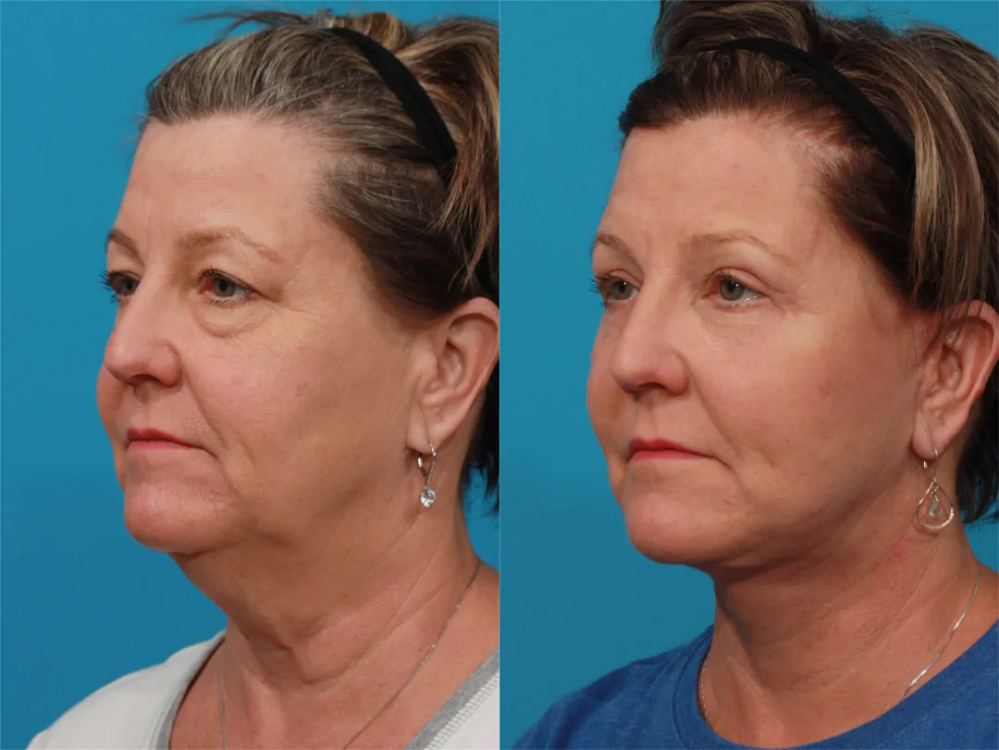 Пациентка пластического хирурга Гукаса Миракяна до и после подтяжки лица