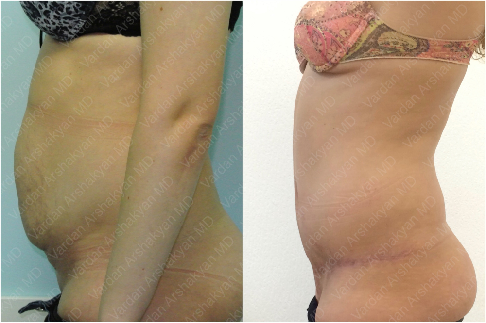 Пациентка пластического хирурга Вардана Аршакяна до и после абдоминопластики