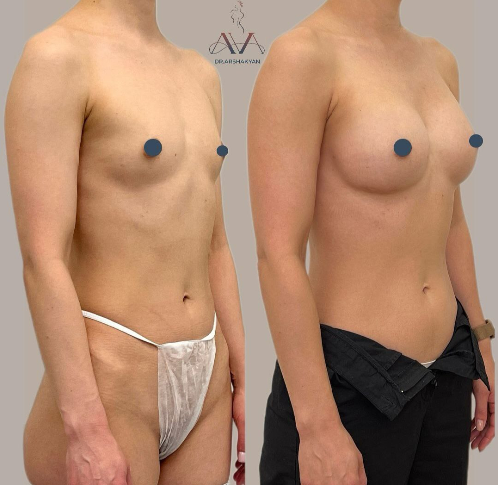 Пациентка пластического хирурга Вардана Аршакяна до и после увеличения груди по методике Natural Beauty