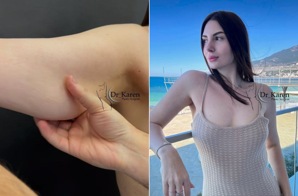 Пациентка пластического хирурга Карена Пайтяна до и после подтяжки и липосакции рук