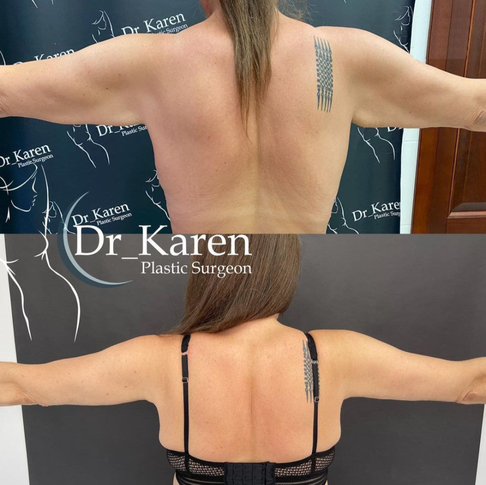 Пациентка пластического хирурга Карена Пайтяна до и после брахиопластики