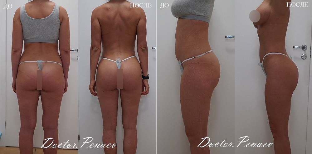 Пациентка доктора Арслана Пенаева до и после вазер-липосакции и липофилинга ягодиц