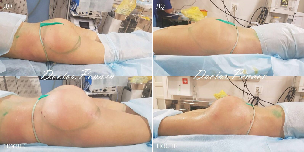 Пациентка доктора Арслана Пенаева. Пример результата липотрансфера