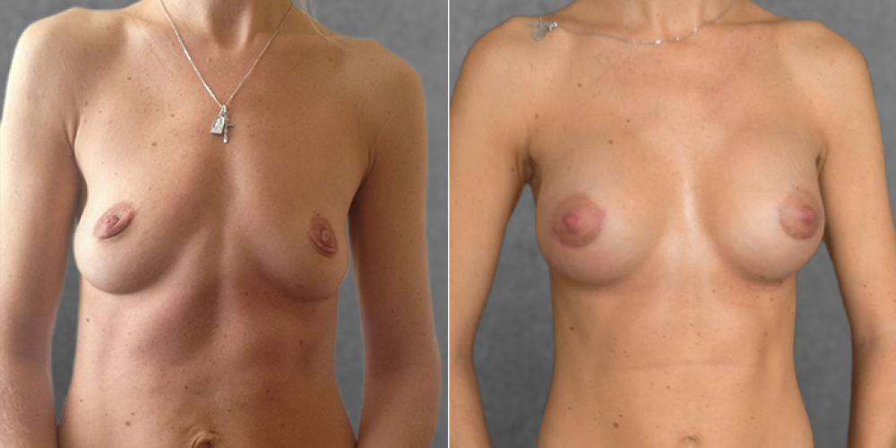 Пациентка Дмитрия Крысина до и после операции по увеличению груди имплантами