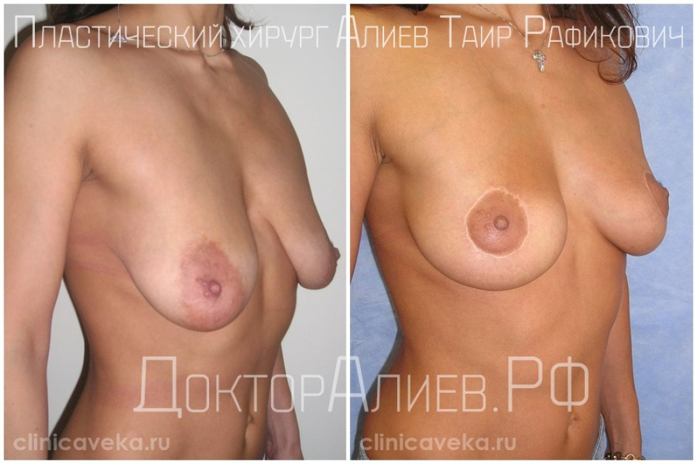 Пациентка до и после операции по подтяжке груди
