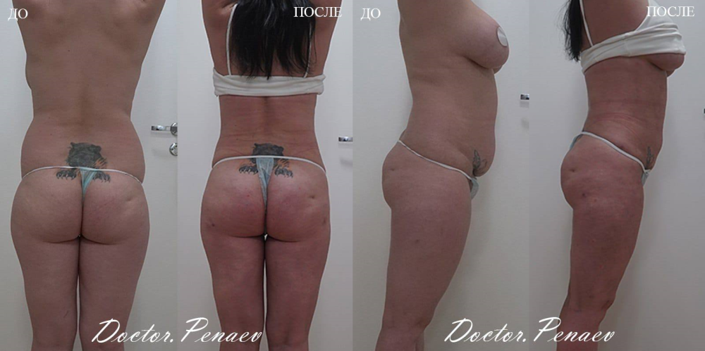 Пациентка доктора Пенаева до и после 3D High Definition VASER-липосакции тела